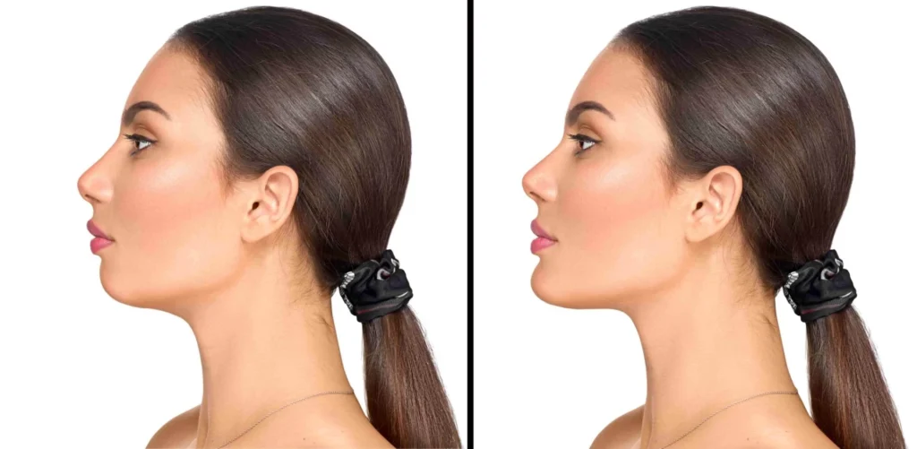 Jaw Angle Implants | Things You Need to Know About Jaw Surgery