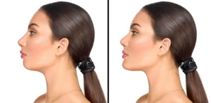jaw angle implants