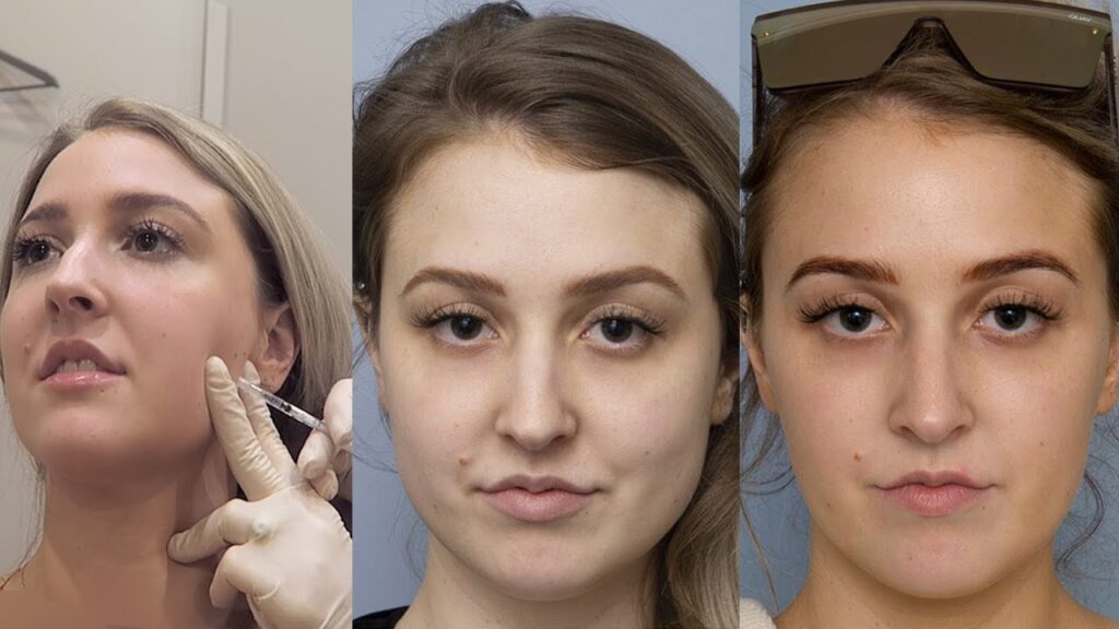 masseter botox before and after