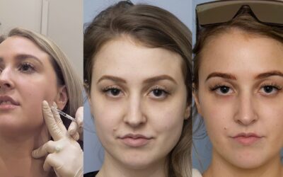 Your Complete Guide to Masseter Botox Before and After masseter botox before and after