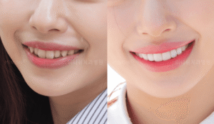 veneers before and after